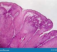 Image result for Genital Condyloma