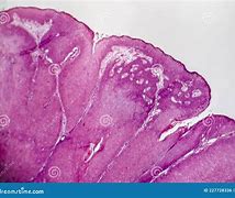 Image result for Genital Condyloma