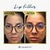 Image result for Lip Line Fillers Before and After