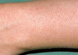 Image result for Raised Red Bump On Arm