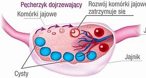 Image result for co_oznacza_zespół_policystycznych_jajników