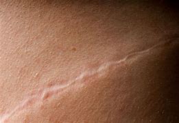 Image result for Cryotherapy Scar
