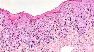 Image result for Squamous Dysplasia