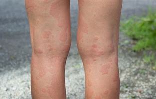 Image result for Shingles On Legs Images