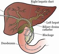 Image result for External Biliary Drain