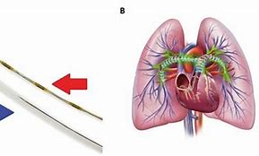 Image result for The Ekos Infusion Catheter