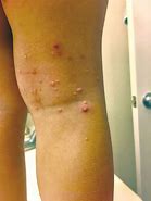 Image result for Water Warts Molluscum Contagiosum