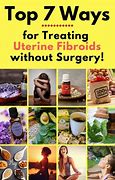 Image result for fibroids herbal remedy