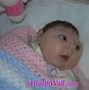 Image result for Person with Microcephaly