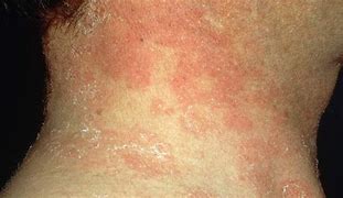 Image result for Red Dry Rash