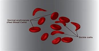 Image result for Sickle Cell Anemia Types