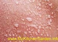 Image result for Worst Sunburn Blister