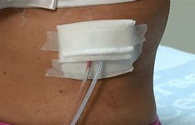 Image result for Drain Tubes After Surgery