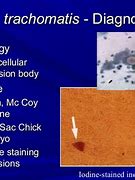 Image result for Chlamydia Trachomatis Symptoms