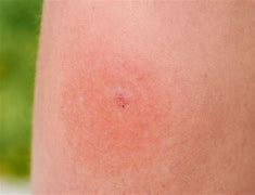 Image result for Cricket Insect Bite
