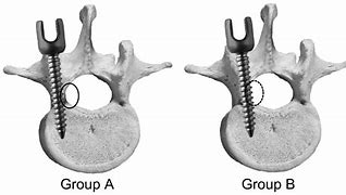 Image result for Picture of an Awl and a Tap in Spine Screw Placement