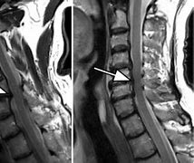 Image result for Cervical Spinal Cord Compression