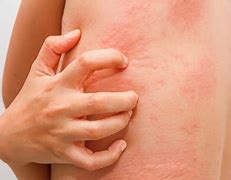 Image result for Rash in Joints From Food Allergy
