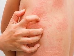 Image result for Food Allergy Symptoms Skin Rash