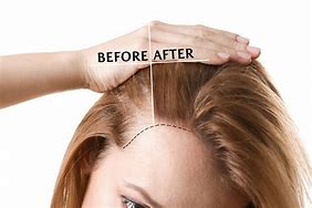 Image result for Hair Thinning Side of Head