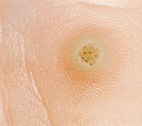 Image result for All the Various Types of Warts