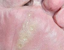 Image result for Corn or Plantar Wart Seed
