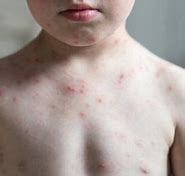 Image result for Shingles Pox