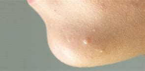 Image result for Cryotherapy Molluscum