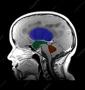 Image result for Hydrocephalus