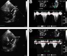 Image result for Echocardiogram of Cardiogenic Shock