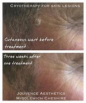 Image result for Seborrhoeic Warts Treatment