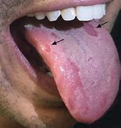 Image result for Syphilis Mouth Ulcer