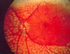 Image result for Diabetes Retinopathy Images