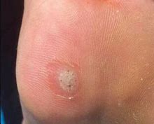 Image result for Corn or Plantar Wart Seed