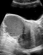 Image result for Endometrioma vs Hemorrhagic Cyst Radiology Ultrasound