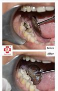 Image result for Tooth Decay Under Filling