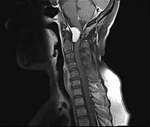 Image result for Meningioma MRI Images