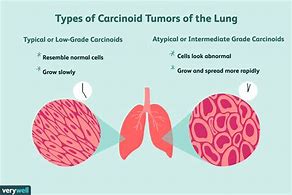 Image result for Malignant Lung Tumor