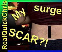 Image result for Back Surgery Scar