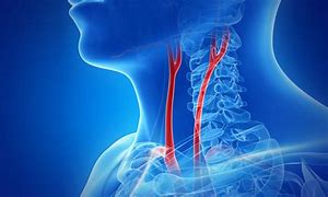 Image result for Carotid Artery Neck Specialist