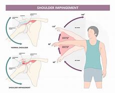Image result for Shoulder Impingement Home Exercises