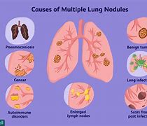 Image result for Right Lower Lung Nodules