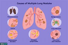 Image result for Types of Pulmonary Nodules