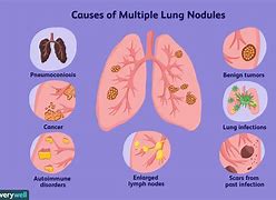 Image result for Spiculated Lung Nodule