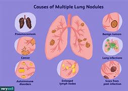 Image result for 1 Cm Lung Nodule