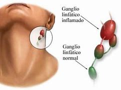 Image result for ganglio