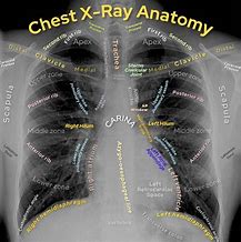 Image result for 2 View Chest X-Ray