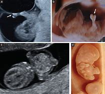 Image result for Fetal Abnormalities