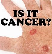 Image result for Keratosis vs Skin Cancer