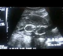 Image result for Intrauterine Fetal Demise Miscarriage Ultrasound